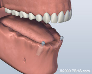 Ball Attachment Denture - Implant Placed