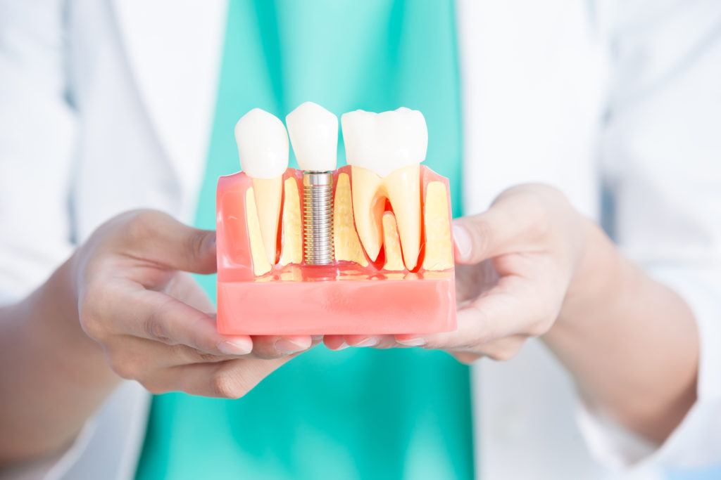 Dental Implants Bethlehem | Dental Implants Allentown