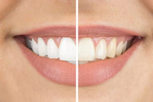 Teeth Whitening Allentown | Teeth Whitening Bethlehem