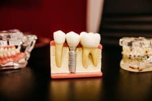 
Root canals
