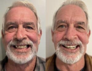 Dental Implants: Before & After