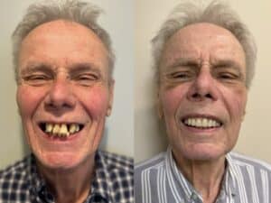 Implant Overdenture: Before & After