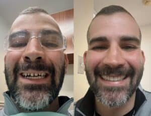 Veneers: Before & After